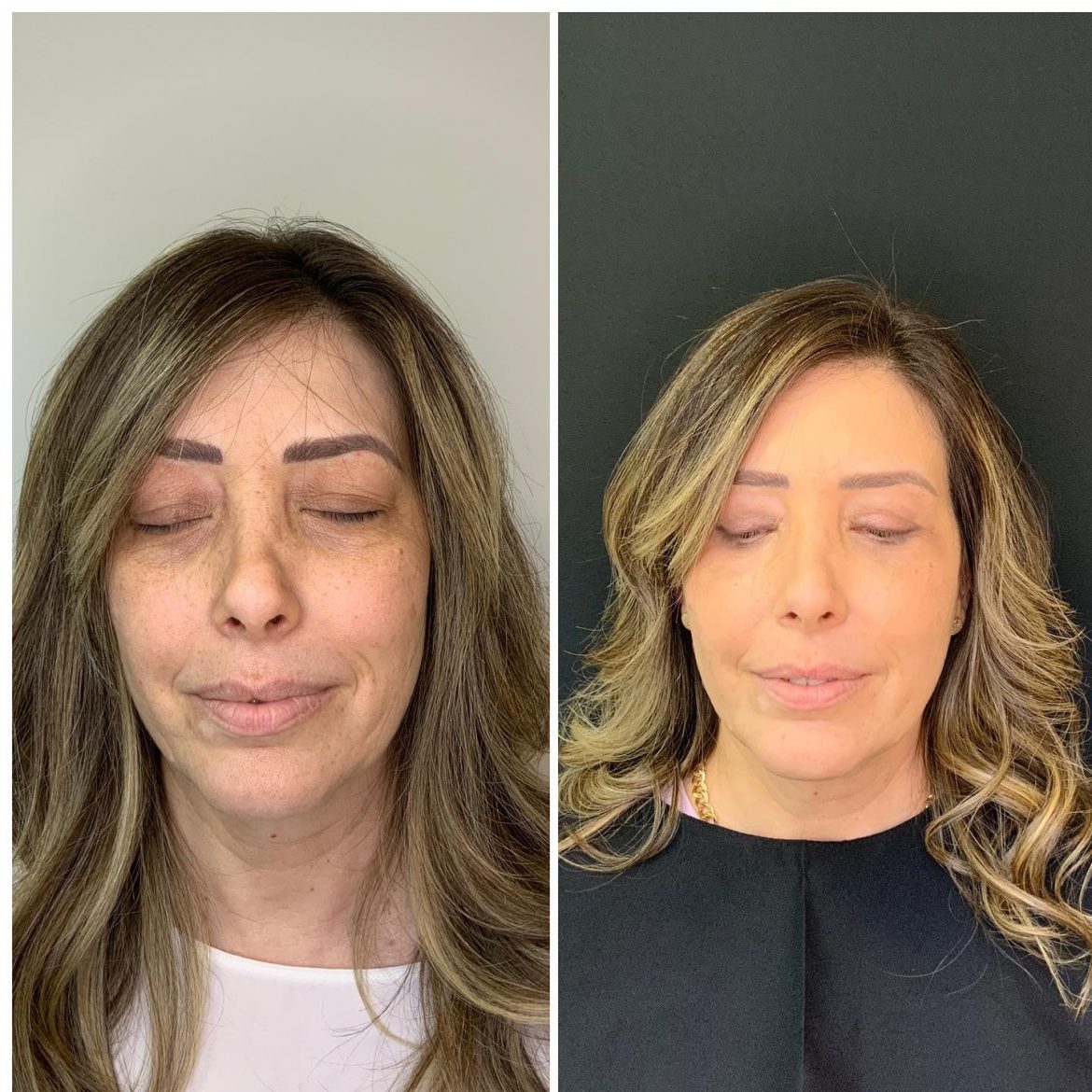 Minha Cirurgia De Blefaroplastia Antes X Depois Andrea Simonetti